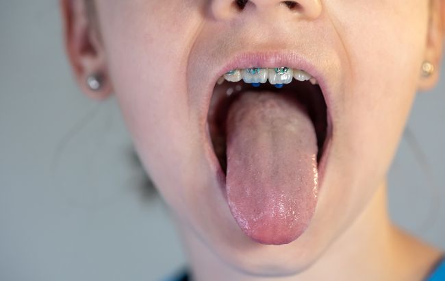 Чому з’являється білий наліт на язику?